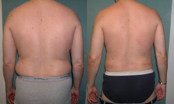 Smart Lipo of Male Abdomen/Flanks