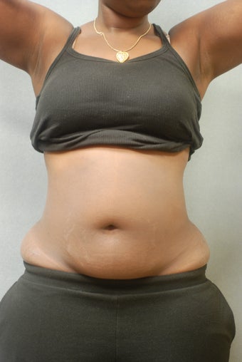 Upper and lower Abdomen & Flanks