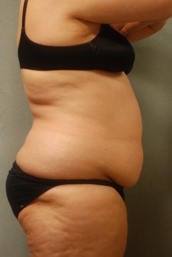 SmartLipo Complete Wrap around 