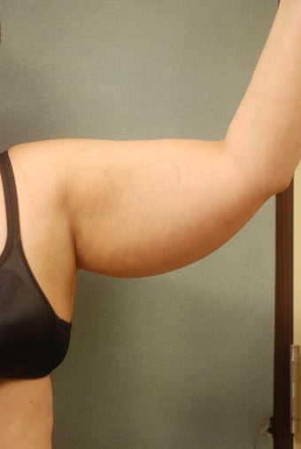 SmartLipo Arms
