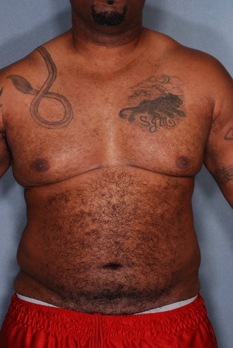 SmartLipo Breasts & Abs 