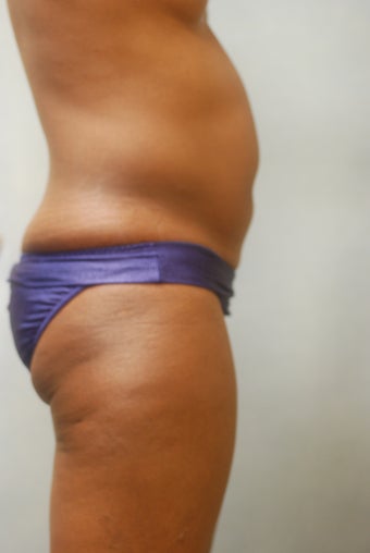 SmartLipo Abs & Love Handles 