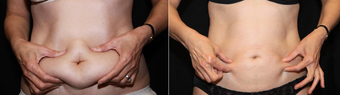 Smart Lipo