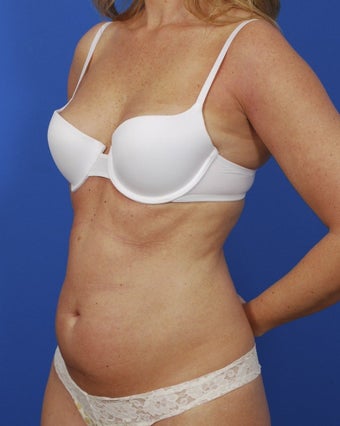 Laser Liposuction