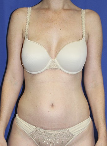 Laser-assisted Liposuction