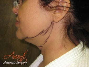 Smart Lipo-Chin