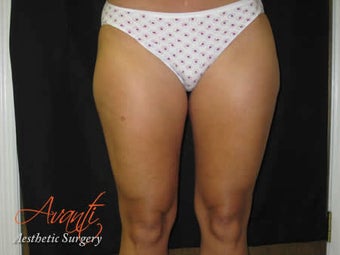 Smart Lipo - Outer Thighs