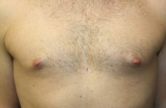 Smart-Lipo of the Chest, Liposuction, Gynecomastia