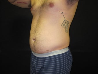 Hi Def Smart Lipo