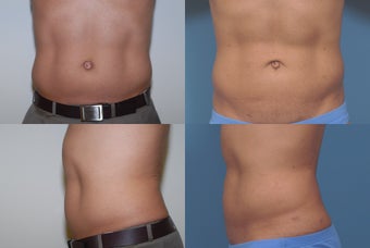 Smartlipo