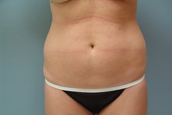 Smartlipo to Full Abdomen and Hip Rolls