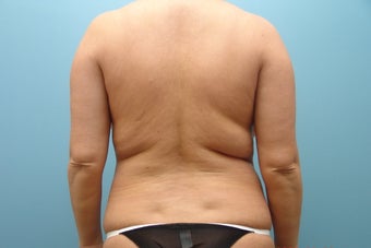 Smartlipo to Full Back
