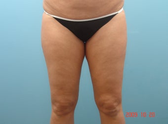 Inner Thigh Smart Liposuction
