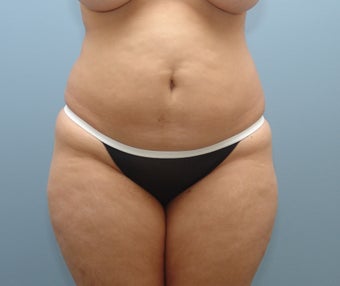 Liposuction to Full Abdomen and Full Back