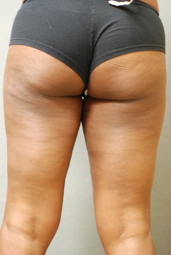 SmartLipo™  Trimming the rubbing Thighs 