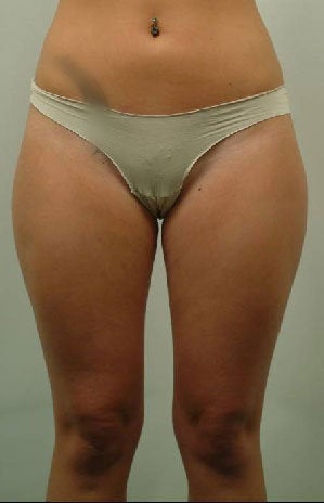Laser Liposuction of Thighs