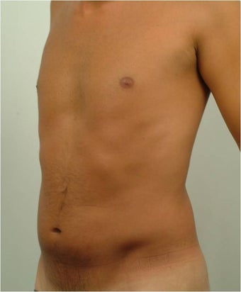 Laser Liposuction 
