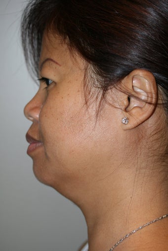 SmartLipo to the neck