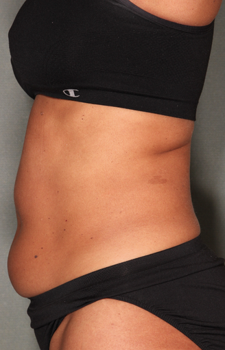 SmartLipo™ 