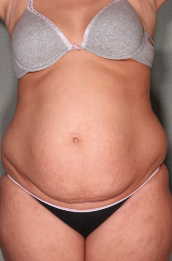 SmartLipo™ 