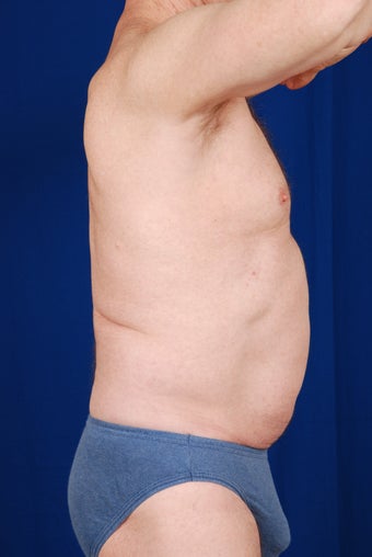 SmartLipo for Abdomen