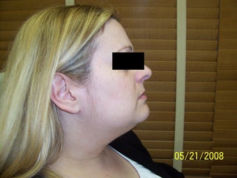Smart-Lipo