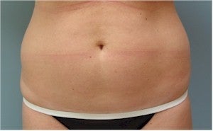 SmartLiposuction