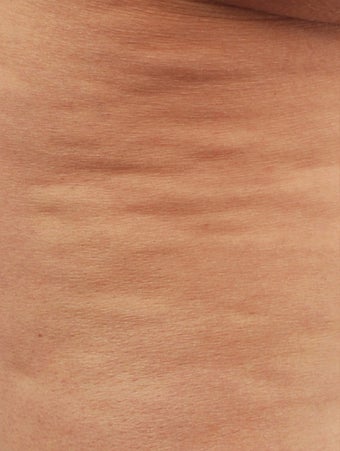 Smart Lipo
