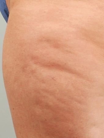 Smart Lipo