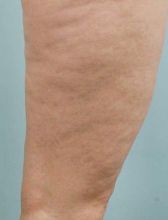 Smart Lipo