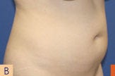 Smart Lipo