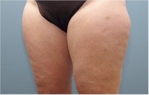Smartlipo