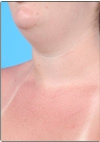 Smart Lipo, Neck Liposuction