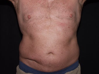Smart Lipo Abs and Flanks