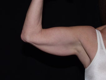 Smart Lipo Arms