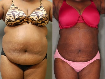37 Year old Female Loses 14" Upper Lower Abs