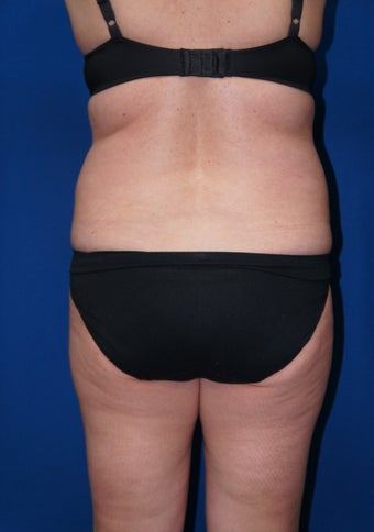 Smart Lipo for back rolls and "muffin top"