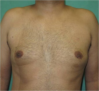 29 Year Old Male Treated for Gynecomastia with Smart Lipo Triplex