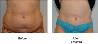 Smart Lipo