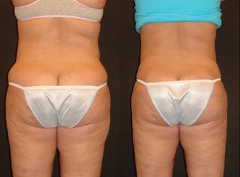 Smart Lipo