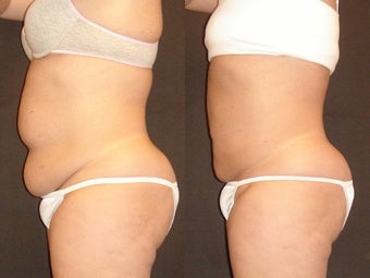 SmartLipo
