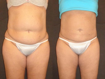 SmartLipo