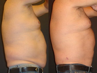 SmartLipo