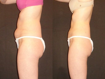 SmartLipo