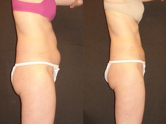 SmartLipo