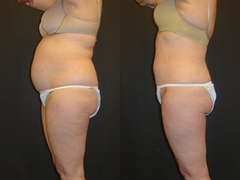 SmartLipo