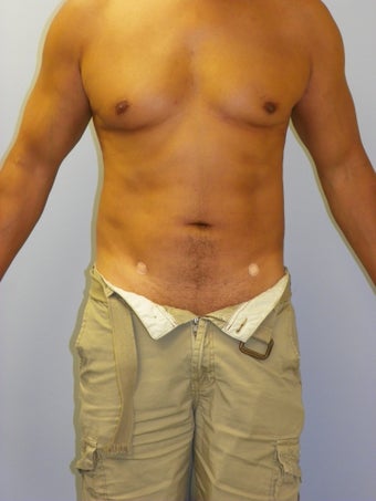 MPX SmartLipo