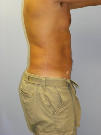 SMARTLipo MPX