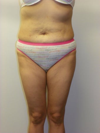SMARTLIPO MPX