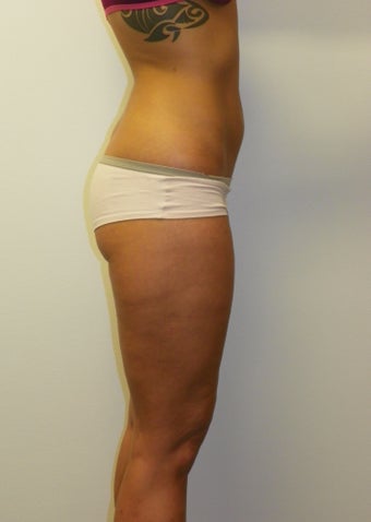 SMARTLIPO MPX